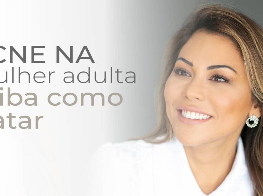 Acne da mulher adulta: o que é e como tratar?