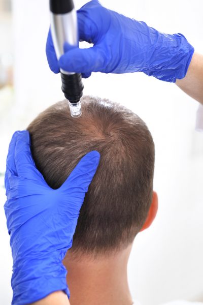 The head of a man with thinning hair during needle mesotherapy